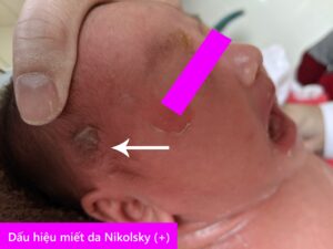 Bé gái sơ sinh bị bong tróc da toàn thân