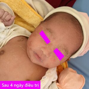 Bé gái sơ sinh bị bong tróc da toàn thân