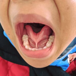 Dính thắng lưỡi ở trẻ cách nhận biết và điệu trị