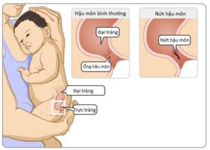 Các dấu hiệu bất thường vùng hậu môn trực tràng