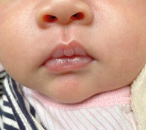 Rộp môi ở trẻ do bú Rộp môi ở trẻ do bú