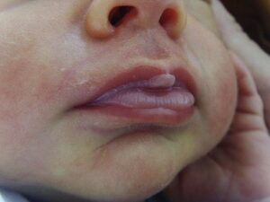 Rộp môi ở trẻ do bú