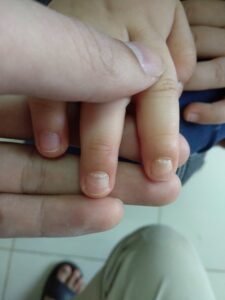 Tổn thương móng sau bệnh tay chân miệng