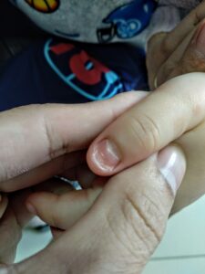 Tổn thương móng sau bệnh tay chân miệng Tổn thương móng sau bệnh tay chân miệng