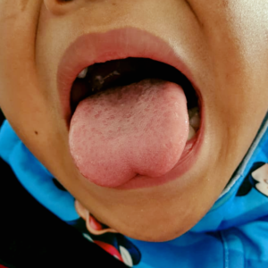 Dính thắng lưỡi ở trẻ