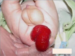 Dấu hiệu sa trực tràng ở em bé